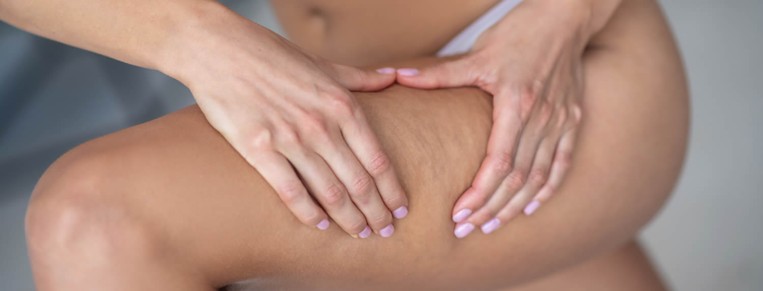 Celulitis