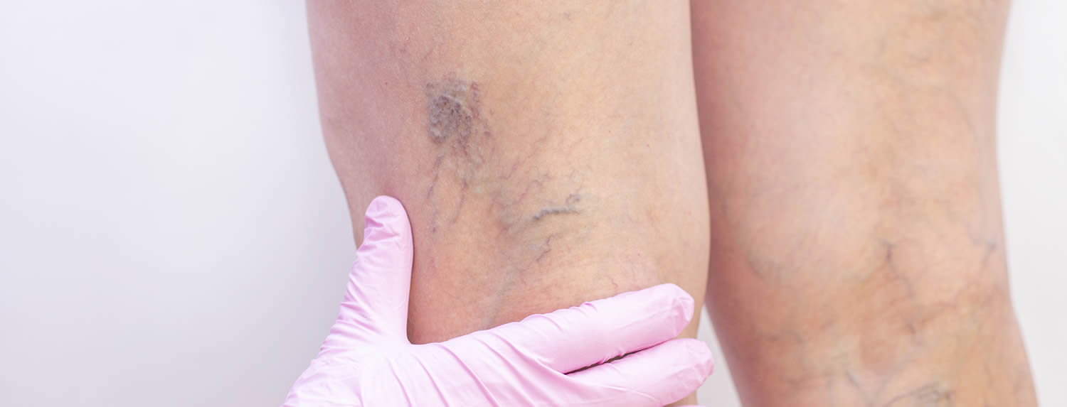 Escleroterapia de varices en miembros inferiores