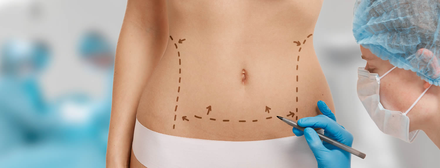 Mini abdominoplastia