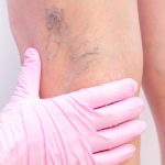 En qué consiste la escleroterapia