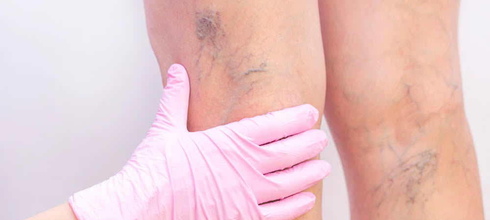 En qué consiste la escleroterapia