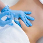 ¿Qué hay de nuevo con la Carboxiterapia?