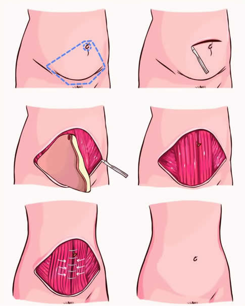 Abdominoplastia HD