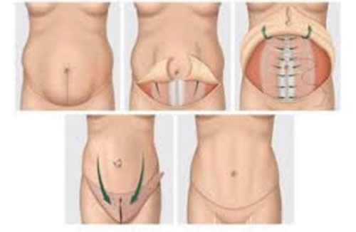 Abdominoplastia HD