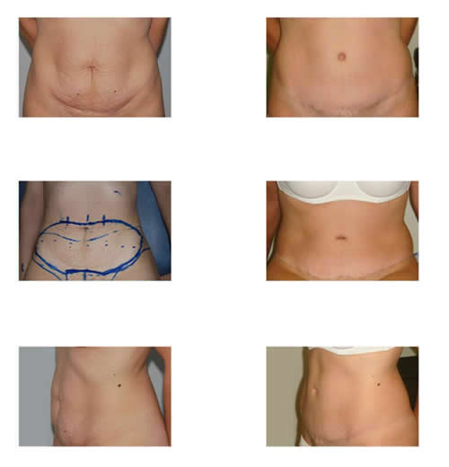 Abdominoplastia HD